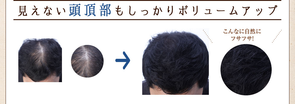 見えない後頭部もしっかりボリュームアップ部分脱毛もシュッとひと吹きでOK